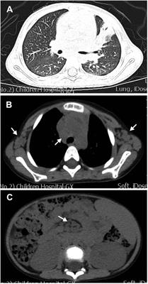 Activated PI3Kδ syndrome 1 mimicking systemic lupus erythematosus and secondary Sjögren's syndrome-like phenotype without recurrent infections: A case report